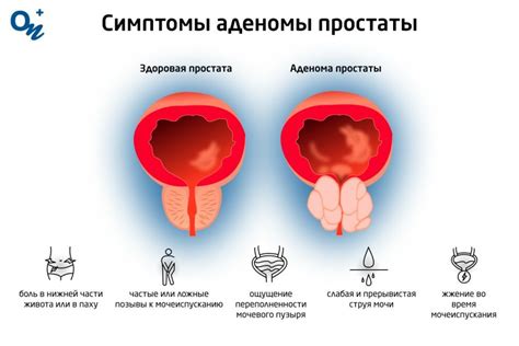 Механизм действия Афалазы и Омника при аденоме простаты: особенности и отличия