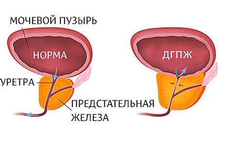 Механизм действия и область применения Афалазы при гиперплазии предстательной железы