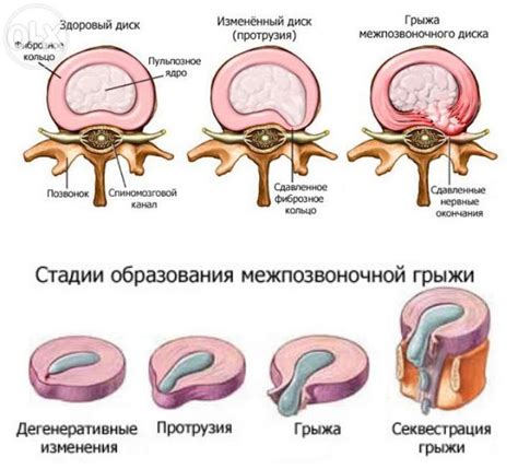 Мнения врачей о действенности турмалинового пояса при лечении грыжи позвоночника