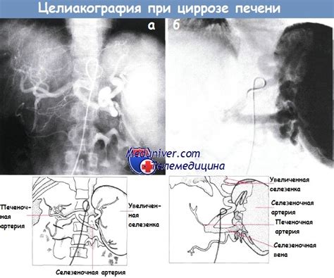 Симптомы гепаторенального синдрома