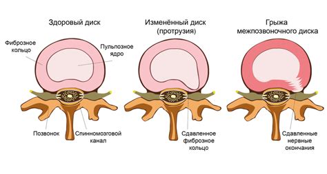 Факты и мифы о воздействии турмалинового пояса на грыжу позвоночника